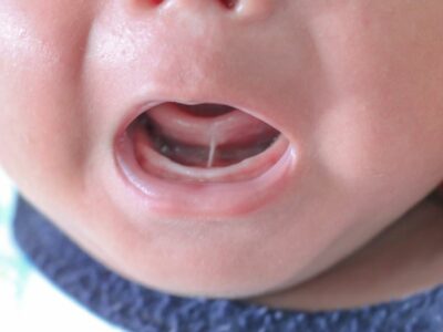 La Sociedad Española de Cirugía Oral y Maxilofacial y de Cabeza y Cuello (SECOMCYC) alerta de un elevado número de cirugías de frenillo lingual innecesarias