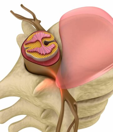 Medicina regenerativa en hernia discal: detrás de la curación mediante la respuesta inmunológica