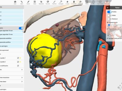 La planificación 3D reduce el tiempo de las cirugías y el riesgo de infecciones urinarias en extirpaciones parciales de riñón, según expertos del curso de cáncer renal