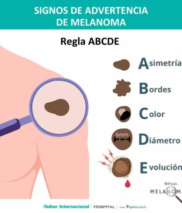 La dermatóloga Irati Allende explica qué es el callo solar y por qué es tan peligroso