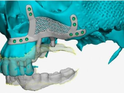 El Dr. Montesdeoca reconstruye el hueso maxilar superior gracias a unos implantes dentales subperiósticos