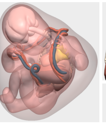 Tecnología 3D española de Cella ayuda a tratar una inusual y compleja lesión torácica en un feto