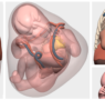 Tecnología 3D española de Cella ayuda a tratar una inusual y compleja lesión torácica en un feto