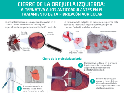 «El cierre de orejuela es una alternativa eficaz para pacientes con fibrilación auricular que no pueden tomar anticoagulantes», doctor José Ramón Rumoroso, jefe de Cardiología del Hospital Quirónsalud Bizkaia