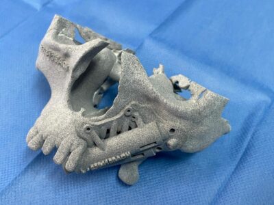 Los implantes cigomáticos mediante cirugía guiada son una solución segura para la rehabilitación de maxilares atróficos o secuelas de tumores