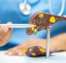 Dr. Alfredo Yoldi, endocrinólogo de Policlínica Gipuzkoa: Una nueva esperanza para el tratamiento del hígado graso