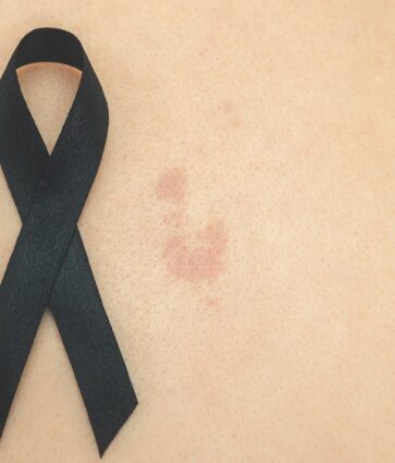 «Exponerse al sol sin protección puede tener consecuencias graves tanto a corto como a largo plazo», explica la dermatóloga Maribel Martínez