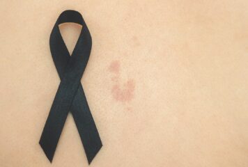 «Exponerse al sol sin protección puede tener consecuencias graves tanto a corto como a largo plazo», explica la dermatóloga Maribel Martínez