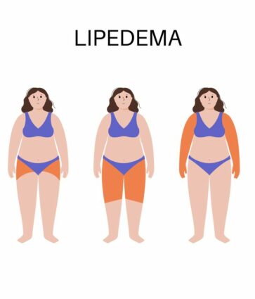 Dolor, hinchazón y dificultad para caminar: así impacta el lipedema en la vida de las mujeres