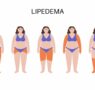 Dolor, hinchazón y dificultad para caminar: así impacta el lipedema en la vida de las mujeres