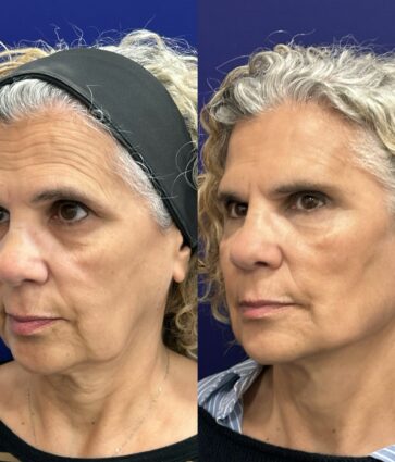 Global Face: nuevo protocolo integral del Dr. Ángel Martín para la recuperación de estructuras faciales, de la firmeza y elasticidad dérmica