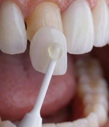 Instituto Volpe presenta Skin Finea®, carillas ultrafinas que preservan el diente propio al 100%