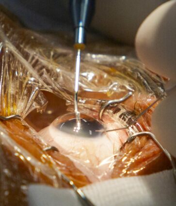 El codirector de FacoElche se somete en directo a la implantación bilateral de una lente diseñada con IA