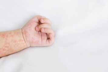 «Es vital mantener actualizado el calendario vacunal para evitar la propagación del sarampión»