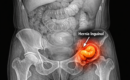 Dr. José Luis Elósegui: «Uno de cada cuatro hombres desarrollará una hernia inguinal a lo largo de su vida»